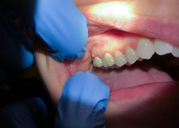 Best Broken or Cracked Tooth Emergency Dentist in Royal Oak, MI